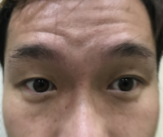 去眼袋手术
