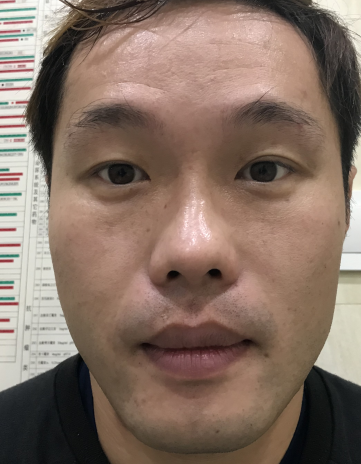 去眼袋手术