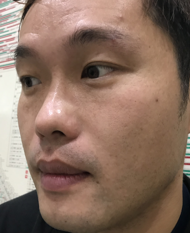 去眼袋手术