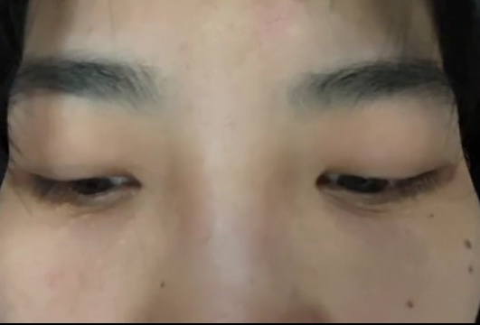 去眼袋手术