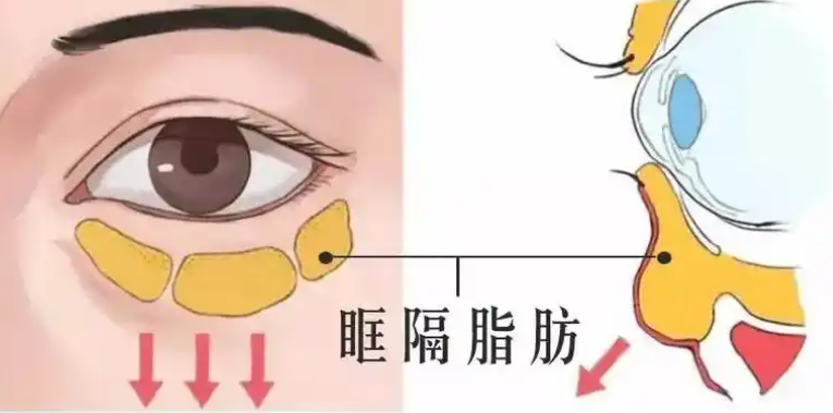 去眼袋手术