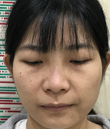 去眼袋手术