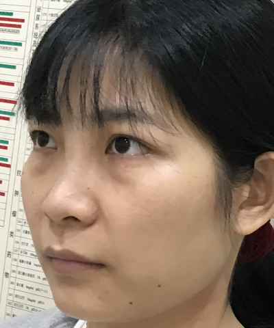 去眼袋手术