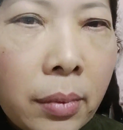 去眼袋手术