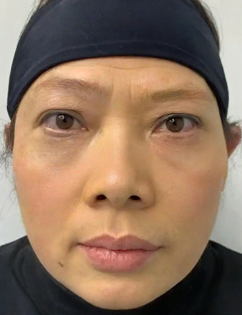 去眼袋手术