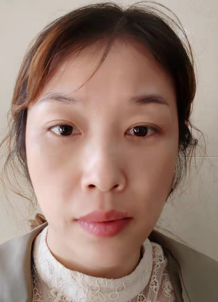 去眼袋手术