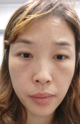 去眼袋手术