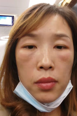 去眼袋手术