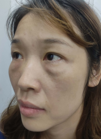去眼袋手术
