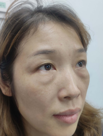 去眼袋手术