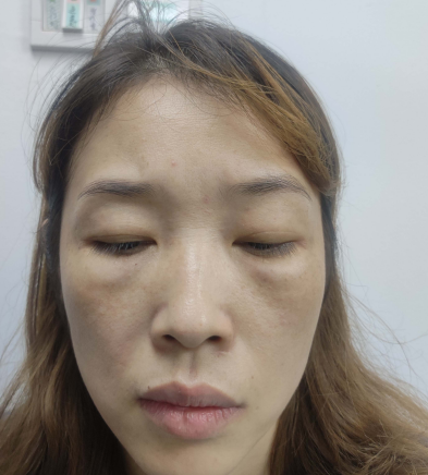 去眼袋手术