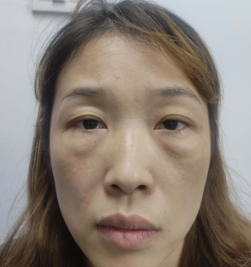 去眼袋手术