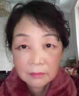 去眼袋手术
