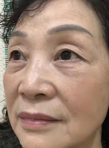 去眼袋手术