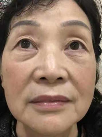 去眼袋手术