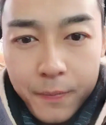 去眼袋手术