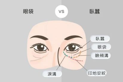 去眼袋手术