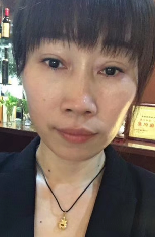 去眼袋手术