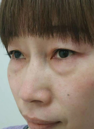 去眼袋手术