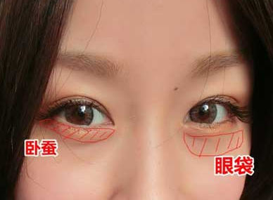 去眼袋手术