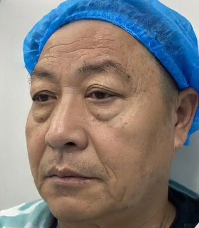 去眼袋手术