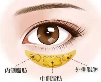 去眼袋手术