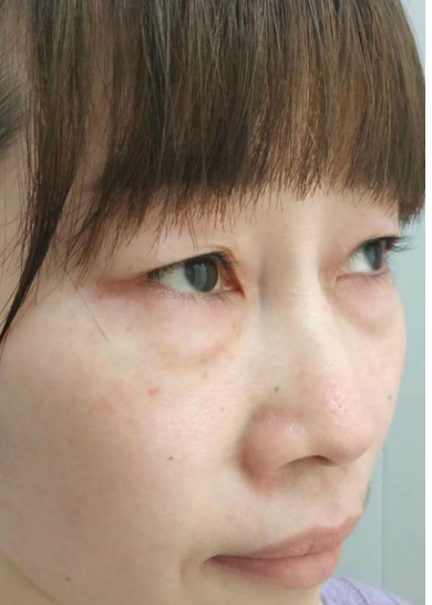 去眼袋手术