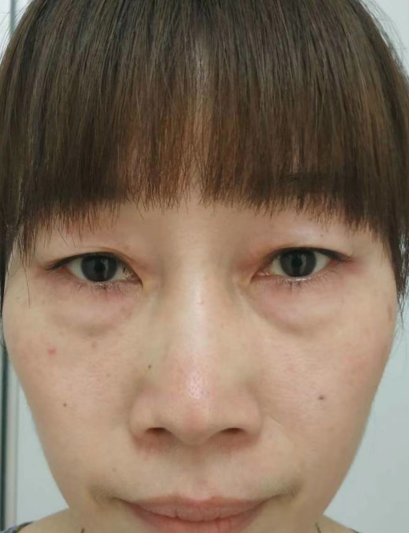 去眼袋手术