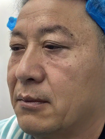 去眼袋手术