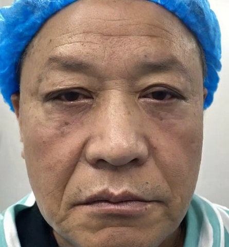 去眼袋手术