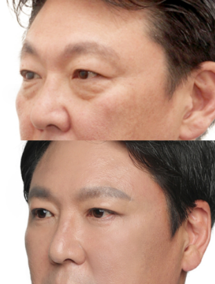 去眼袋手术