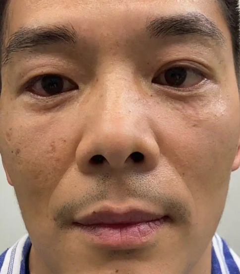 去眼袋手术