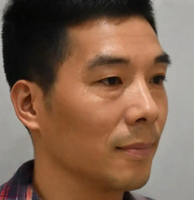 去眼袋手术