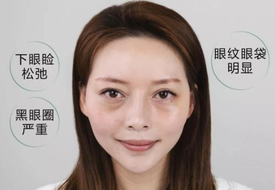 去眼袋手术