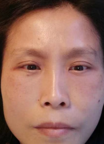 去眼袋手术