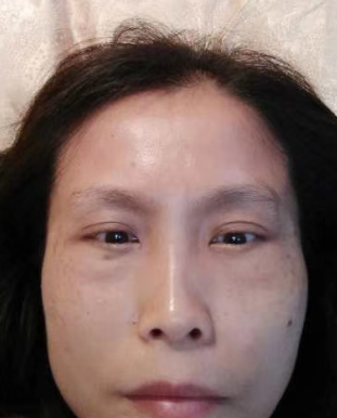 去眼袋手术