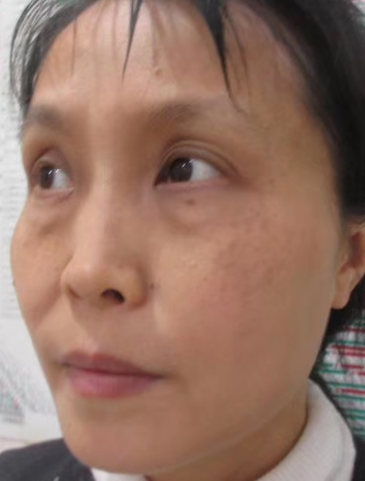 去眼袋手术
