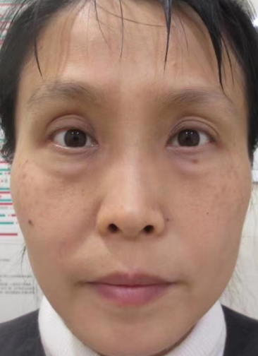 去眼袋手术