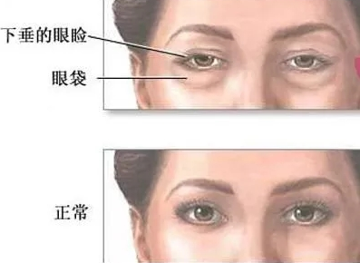 去眼袋手术