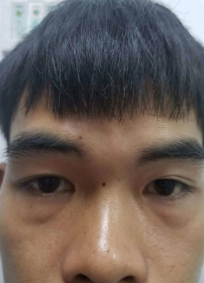 去眼袋手术