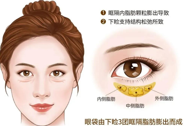 去眼袋手术