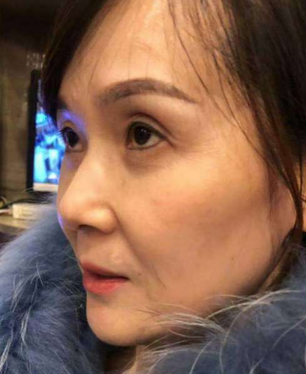 去眼袋手术