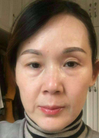 去眼袋手术