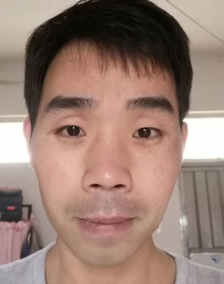去眼袋手术