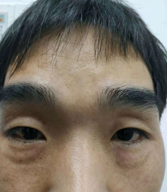 去眼袋手术