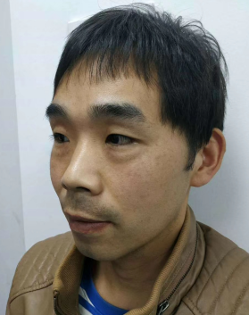 去眼袋手术