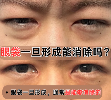 去眼袋手术