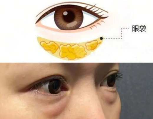 去眼袋手术