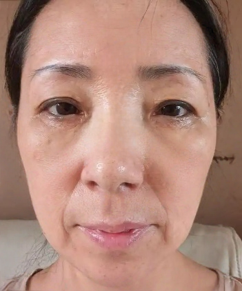 去眼袋手术