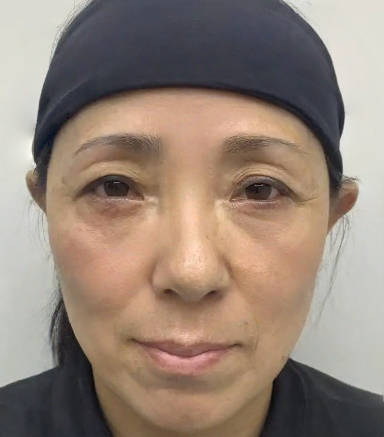 去眼袋手术